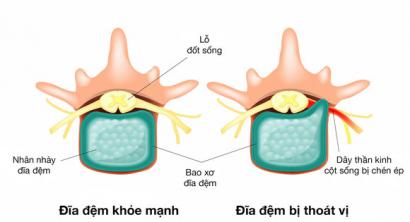Biến chứng và cách chữa thoát vị đĩa đệm